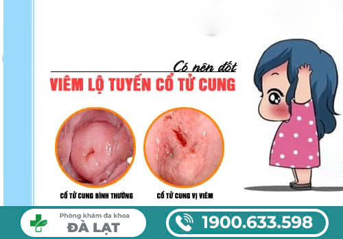 Có nên đốt viêm lộ tuyến không - Lời khuyên từ các chuyên gia 
